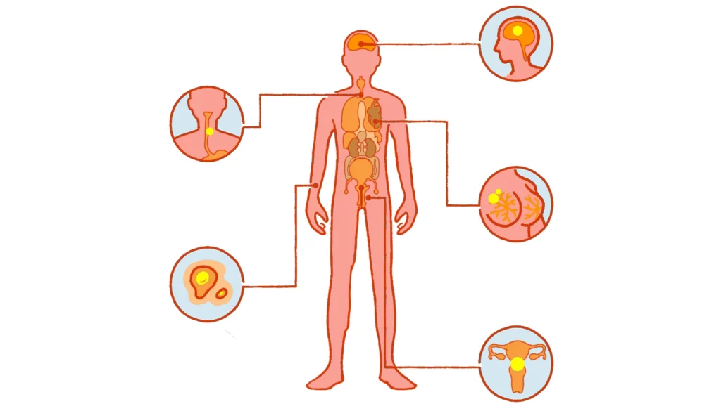 Image depicts on which cancer Sodium DCA works.